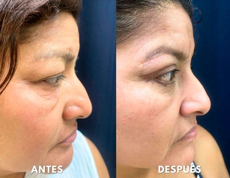Blefaroplastia Laser