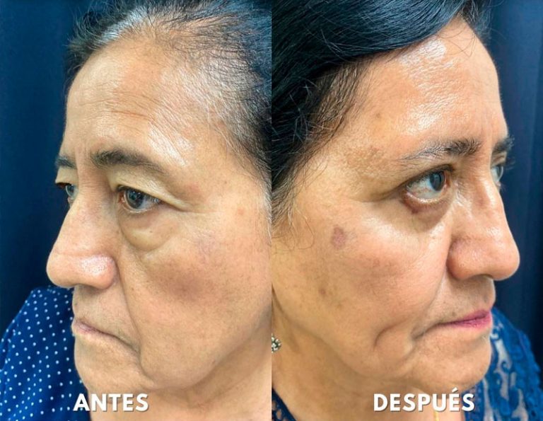 Blefaroplastia Laser