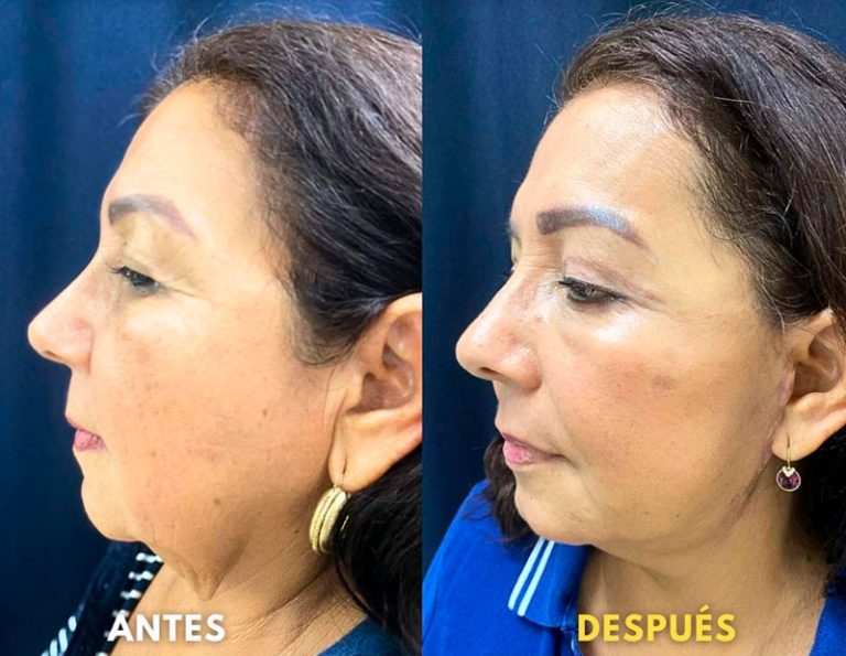 Blefaroplastia