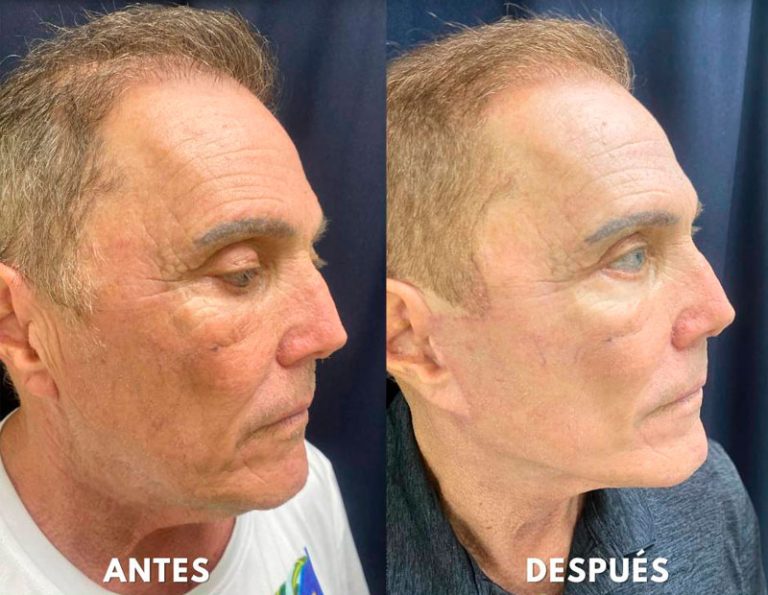 lifting_cervico_laser_manta_manabi_01