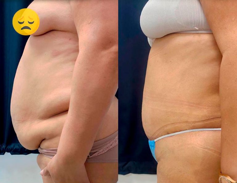 lipoescultura_manta_manabi_02