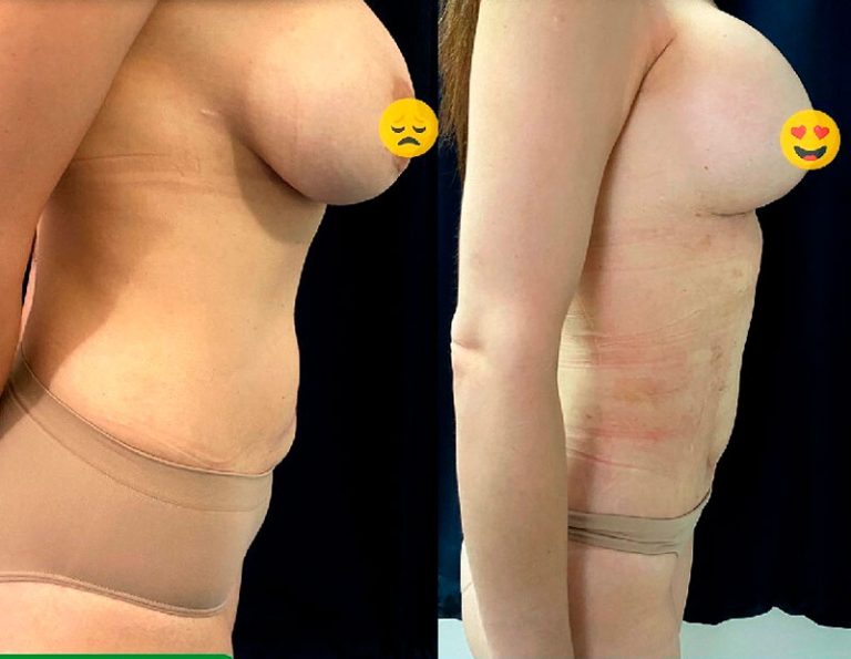 lipoescultura_manta_manabi_03