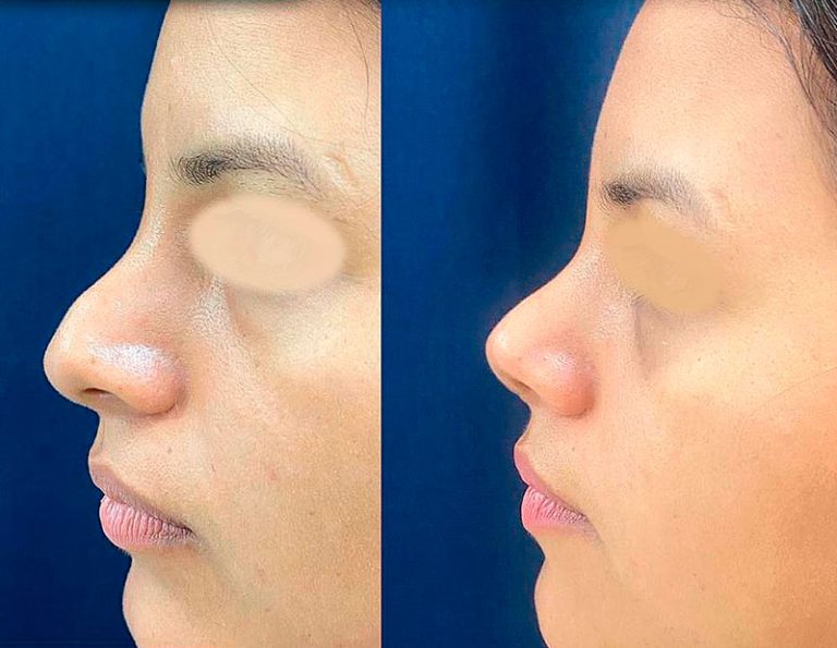 Rinoplastia Secundaria