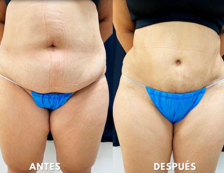 Abdominoplastia