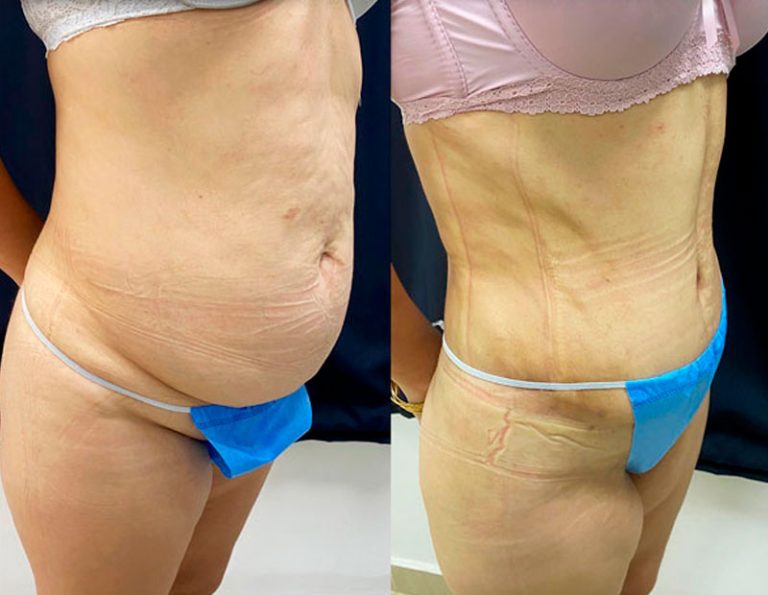 Abdominoplastia