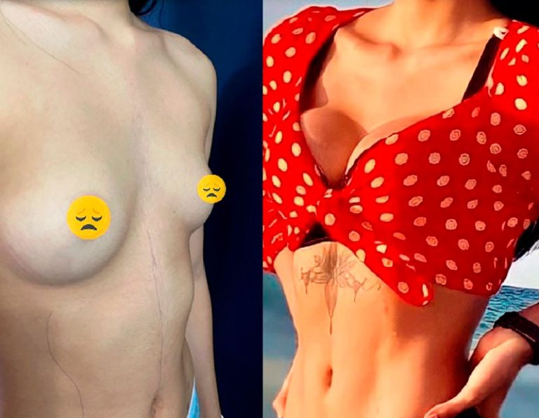 Lipo HD y aumento mamario