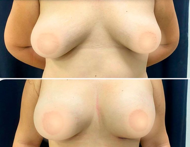 Lipo HD y aumento mamario