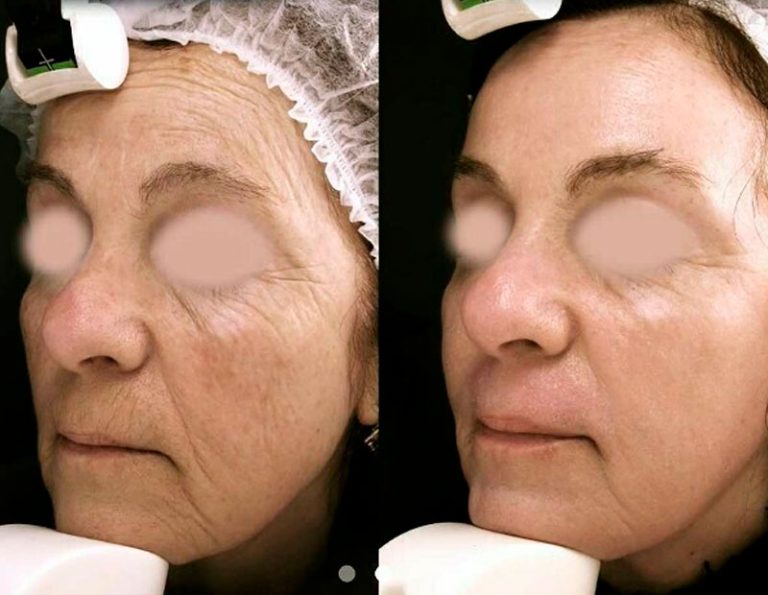 Rejuvenecimiento Facial - Laser CO2 fraccionado