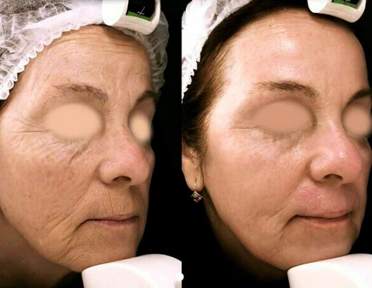 Rejuvenecimiento Facial - Laser CO2 fraccionado